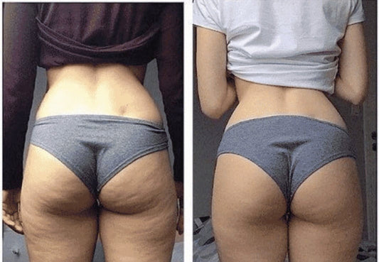Lifting colombien et traitement de la cellulite